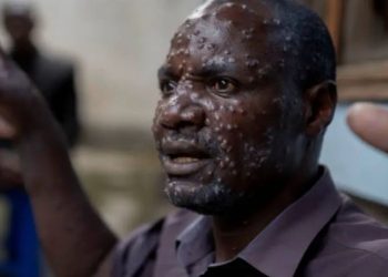 Viruela del mono: OMS pide aumentar producción de vacunas para frenar nueva cepa.