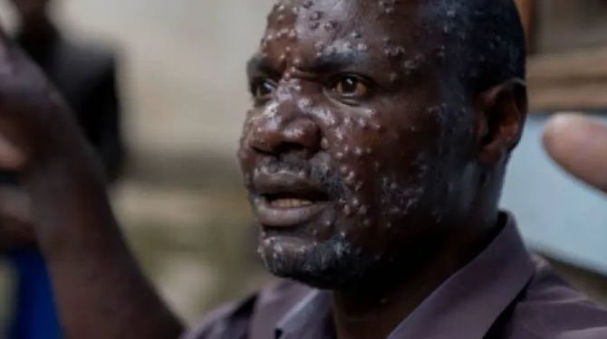 Viruela del mono: OMS pide aumentar producción de vacunas para frenar nueva cepa.