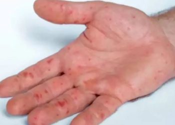 Tras casos de viruela del mono en Sonora, se ha reforzado vigilancia epidemiológica.