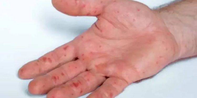 Tras casos de viruela del mono en Sonora, se ha reforzado vigilancia epidemiológica.