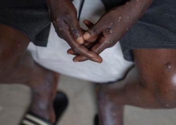 UE abordará este lunes medidas ante la emergencia sanitaria por brote de mpox en la República Democrática del Congo.