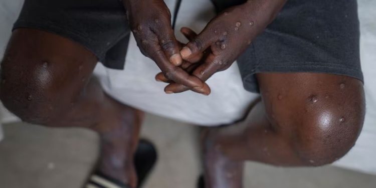 UE abordará este lunes medidas ante la emergencia sanitaria por brote de mpox en la República Democrática del Congo.