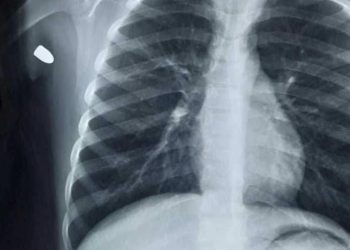 Bala perdida hiere a menor de 8 años durante celebraciones de Año Nuevo en Nogales.