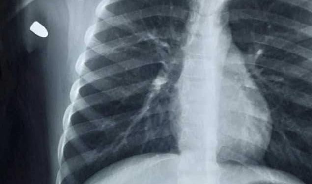 Bala perdida hiere a menor de 8 años durante celebraciones de Año Nuevo en Nogales.