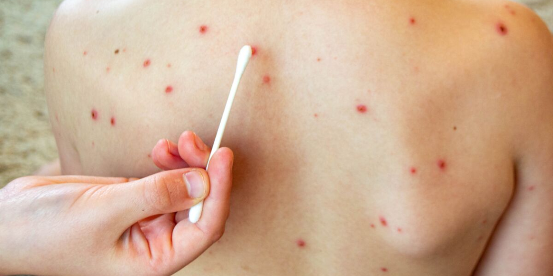 Cuatro casos de sarampión detectados en Sonora son importados de Chihuahua.