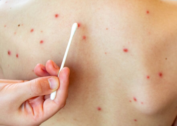 Cuatro casos de sarampión detectados en Sonora son importados de Chihuahua.