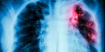 Sonora acumula mil 89 casos de tuberculosis en 2025 y puede afectar a cualquiera.