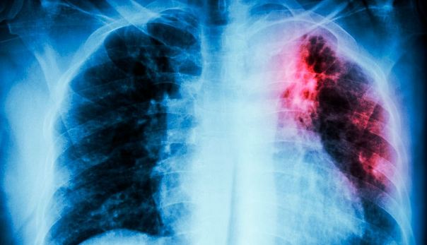 Sonora acumula mil 89 casos de tuberculosis en 2025 y puede afectar a cualquiera.