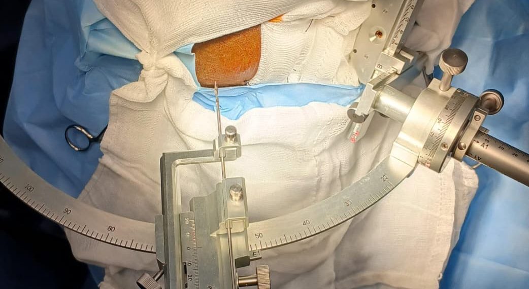 Realiza con éxito ISSSTE Morelos primera biopsia cerebral en beneficio de un paciente de 48 años