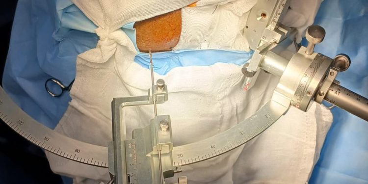 Realiza con éxito ISSSTE Morelos primera biopsia cerebral en beneficio de un paciente de 48 años