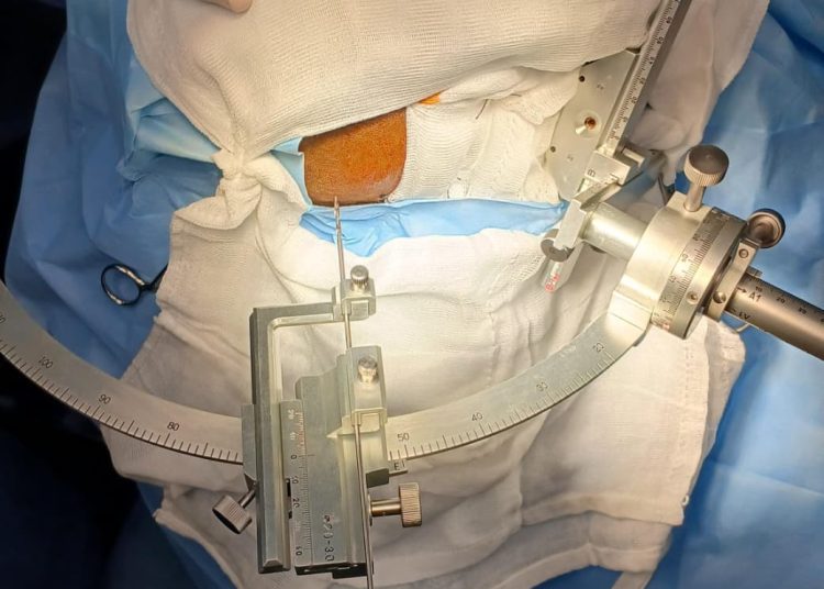 Realiza con éxito ISSSTE Morelos primera biopsia cerebral en beneficio de un paciente de 48 años